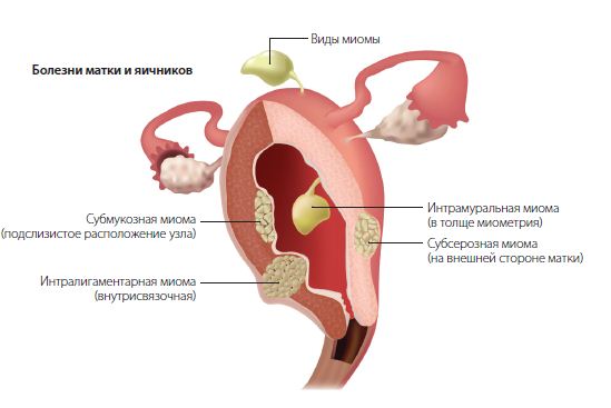 Что такое лапароскопия